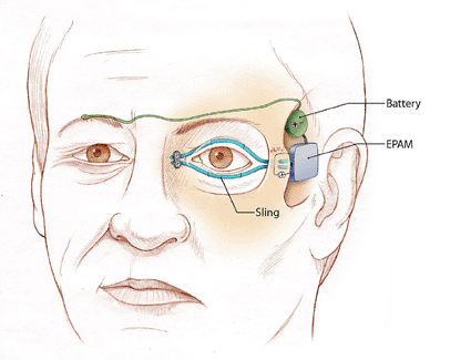 Image: Illustration of left eyelid sling attached to the electroactive polymer artificial muscle device (EPAM) after passing through an interpolation unit implanted in the lateral orbital wall (note screw fixation). The power supply and artificial muscle are implanted in the temporal fossa. Conceptually, when the normal right eyelid blinks, the electrical sensor (green) sends a signal to the battery to activate the EPAM (photo courtesy UC Davis). Image: Illustration of left eyelid sling attached to the electroactive polymer artificial muscle device (EPAM) after passing through an interpolation unit implanted in the lateral orbital wall (note screw fixation). The power supply and artificial muscle are implanted in the temporal fossa. Conceptually, when the normal right eyelid blinks, the electrical sensor (green) sends a signal to the battery to activate the EPAM (photo courtesy UC Davis).